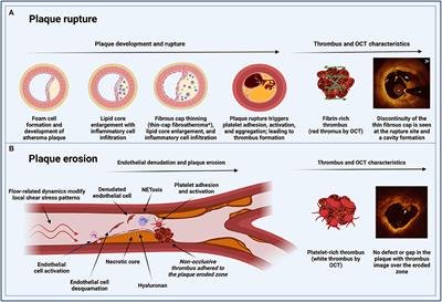 The Role of Antiplatelet Therapy in Patients With MINOCA